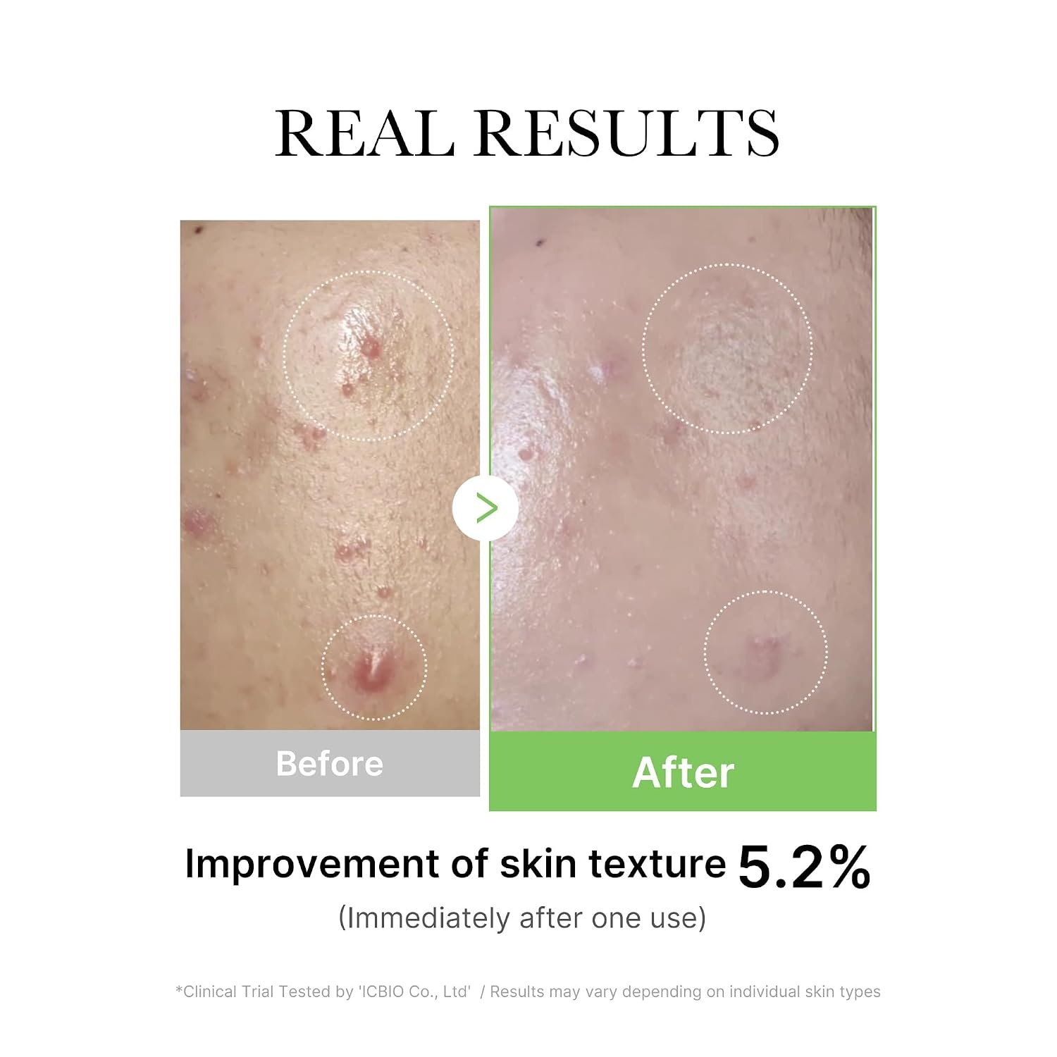 image:imageMedicube Exosome Cica Tea Tree Ampoule for Sensitive Skin with Centella Asiatica help reduce redness and breakouts Lowirritating Moisturizing amp Soothing Serum Korean Skincare 30ml